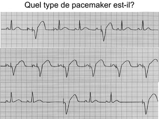 Quel type de pacemaker est-il?
 