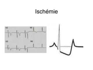 Ischémie
 