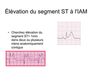Élévation du segment ST à l'IAM


 • Cherchez élévation du
   segment ST> 1mm
   dans deux ou plusieurs
   mène anatomiquement
   contigus
 