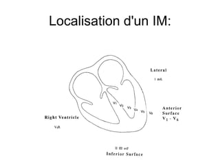 Localisation d'un IM:
 