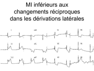 MI inférieurs aux
 changements réciproques
dans les dérivations latérales
 