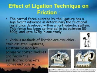 Effect of Ligation Technique on
Friction :
• The normal force exerted by the ligature has a
significant influence in determining the frictional
resistance developed within an orthodontic system.
This force has been estimated to be between 50-
300g, and upto 375g in one study.
• Various methods of ligation are available: -
stainless steel ligatures,
elastomeric modules,
polymeric coated modules
and finally the
self ligating brackets,
active and passive.
 