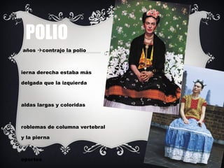 POLIO



años contrajo la polio


ierna derecha estaba más
delgada que la izquierda


aldas largas y coloridas


robl...