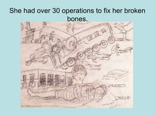 She had over 30 operations to fix her broken
bones.
 