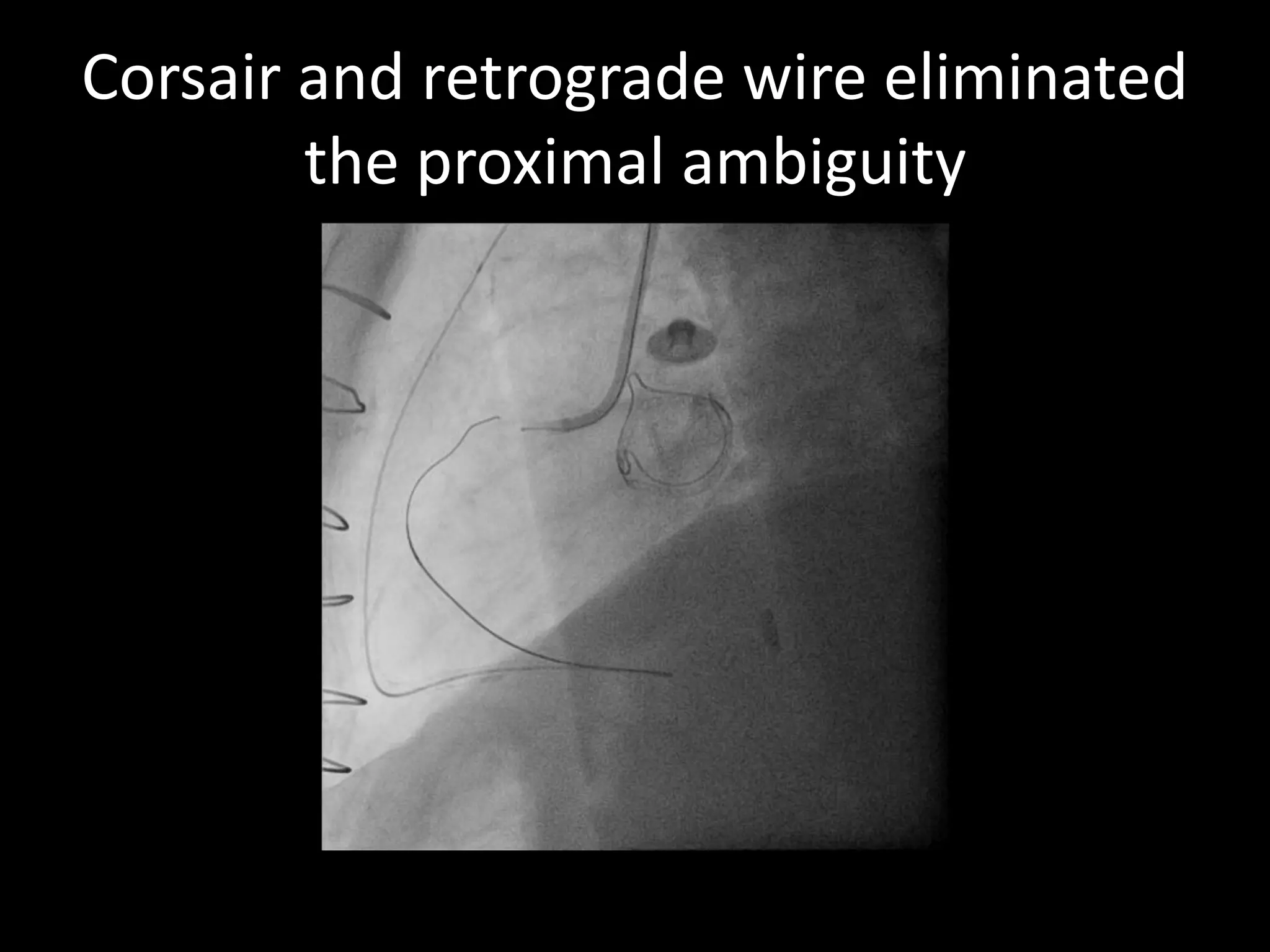 Corsair and retrograde wire eliminated
the proximal ambiguity