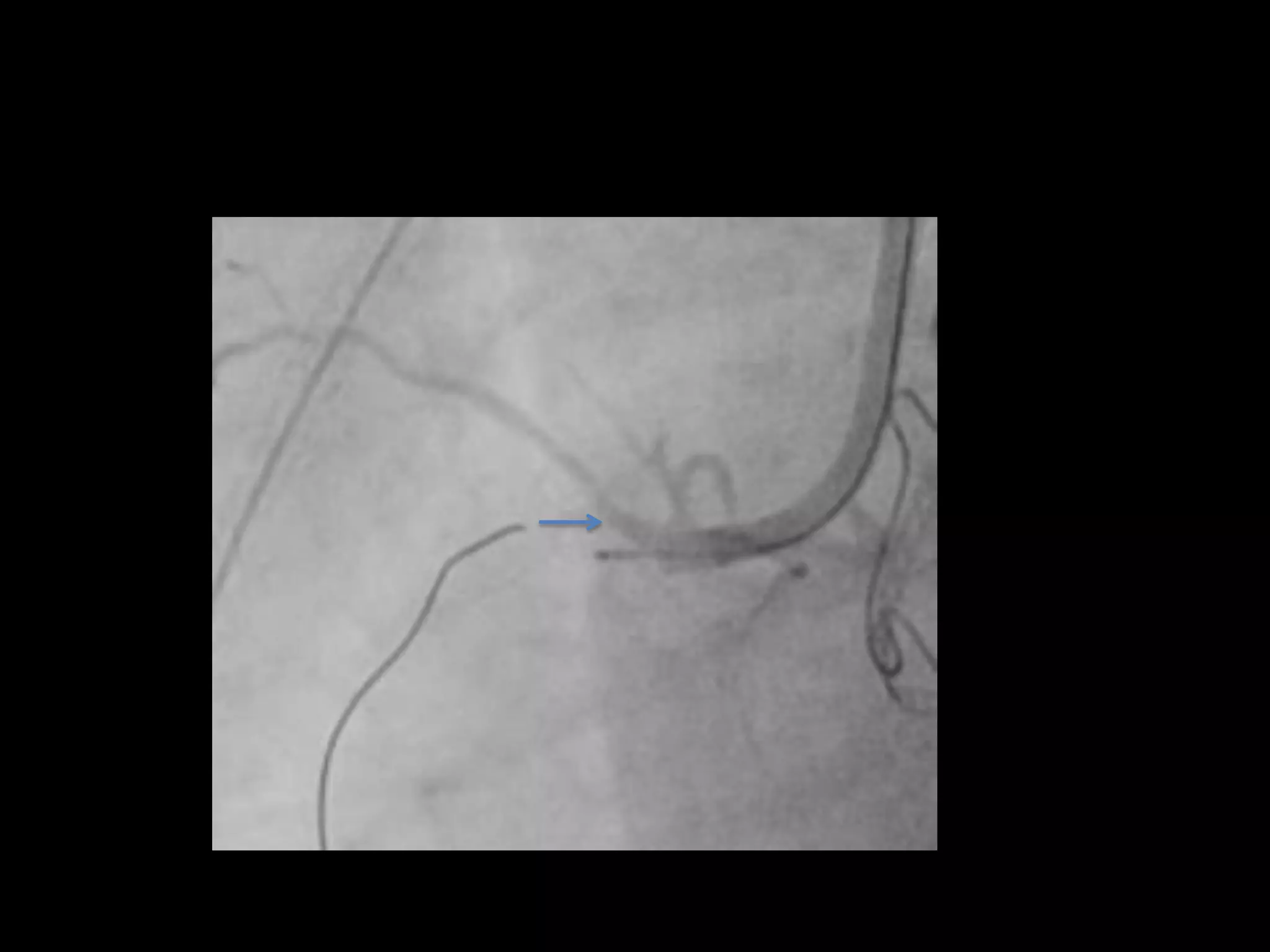 Probable location of prox. cap