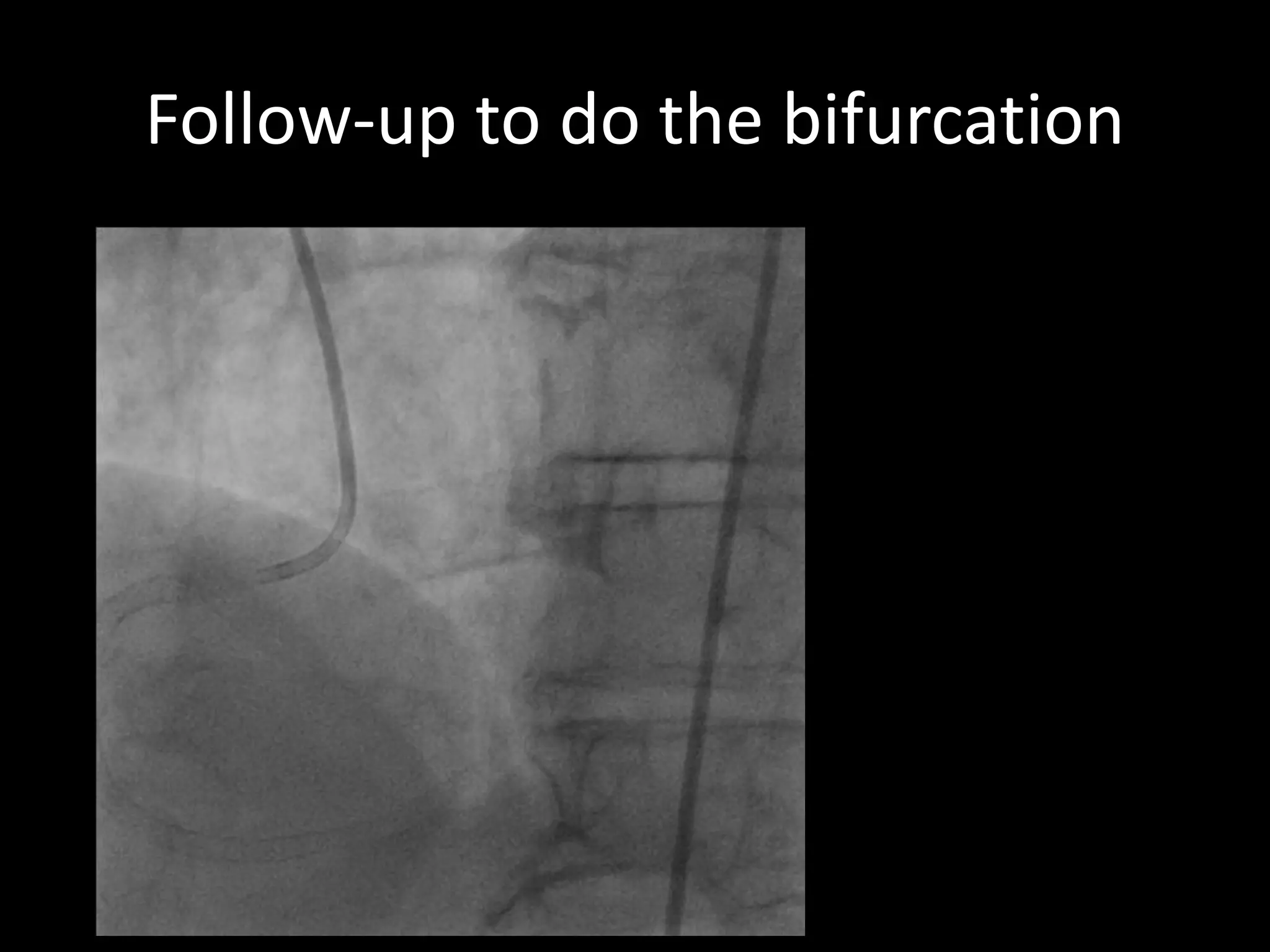 No symptoms
We decided to do
nothing
Follow-up to do the bifurcation