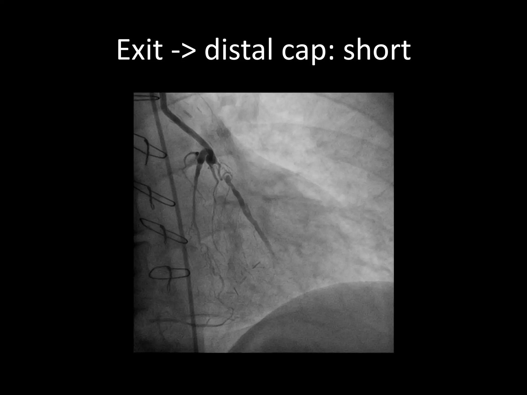 Exit -> distal cap: short