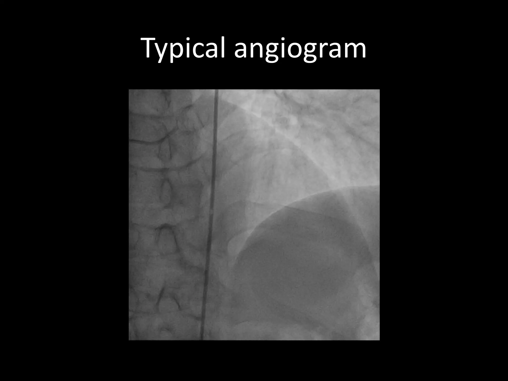 Typical angiogram