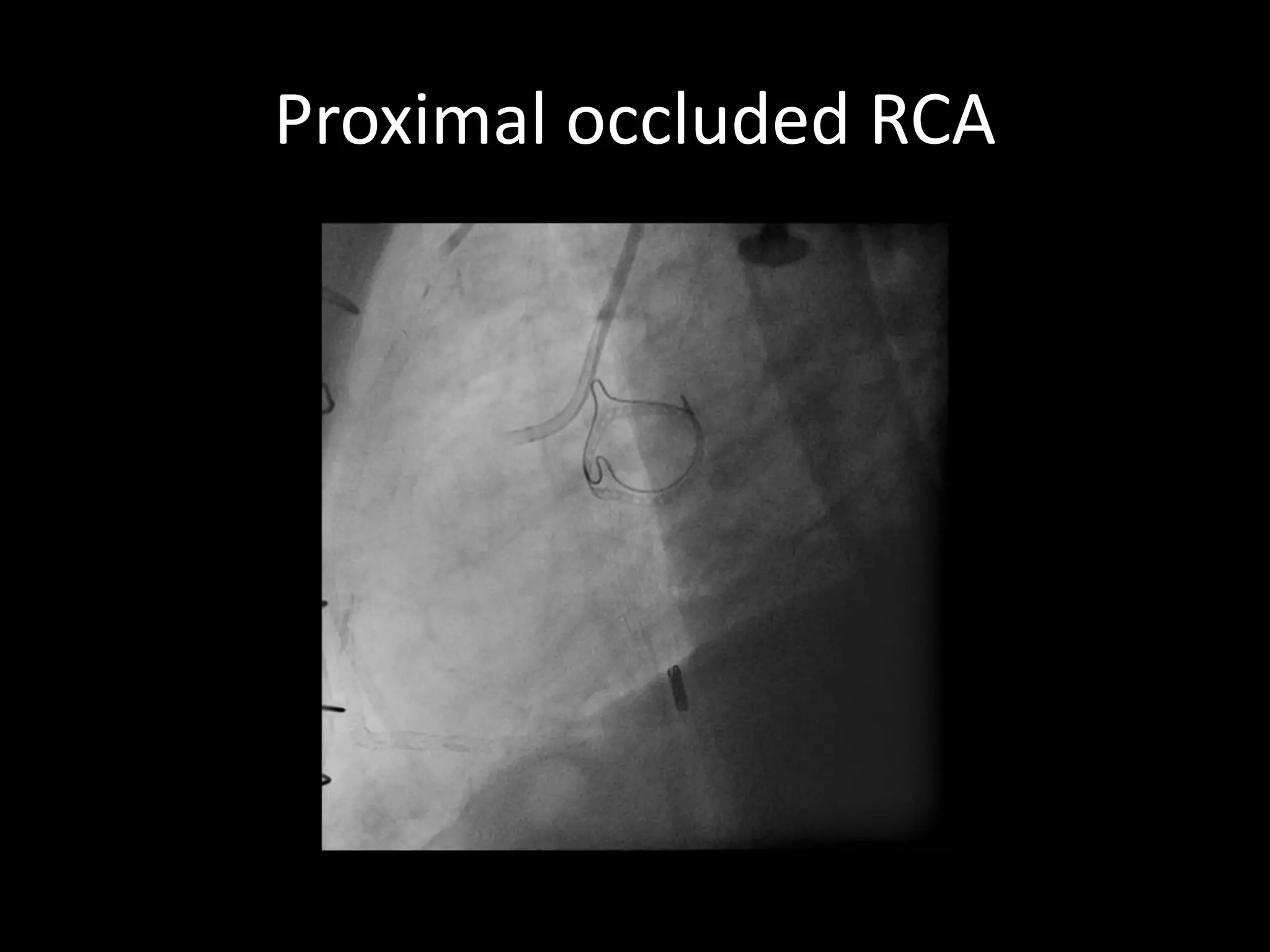 Proximal occluded RCA