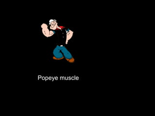 Popeye muscle
 