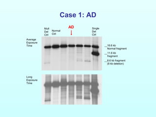 Case 1: AD
Single
Del
Ctrl
Normal
Ctrl
16.6 kb
Normal fragment
8.6 kb fragment
(8 kb deletion)
Average
Exposure
Time
Long
Exposure
Time
11.6 kb
fragment
Mult
Del
Ctrl
AD
 