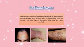 Tratamiento de las manifestaciones inflamatorias de las dermatosis
hiperqueratosis y secas sensibles a los corticosteroides, como por
ejemplo, psoriasis, liquen, dermatitis seborreica del cuero
cabelludo
 