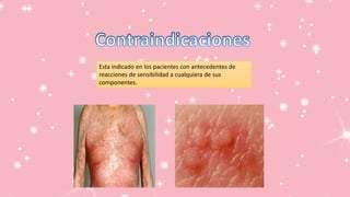 Esta indicado en los pacientes con antecedentes de
reacciones de sensibilidad a cualquiera de sus
componentes.
 