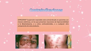 DIPROSPAN® Suspensión inyectable está contraindicado en pacientes con
micosis sistémicas, en los que presentan reacciones de hipersensibilidad
a la Betametasona, o a otros corticosteroides, o a cualquier otro
componente de este producto.
 