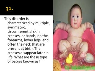 This disorder is
  characterized by multiple,
  symmetric,
  circumferential skin
  creases, or bands, on the
  forearms, lower legs, and
  often the neck that are
  present at birth. The
  creases disappear later in
  life. What are these type
  of babies known as?
 