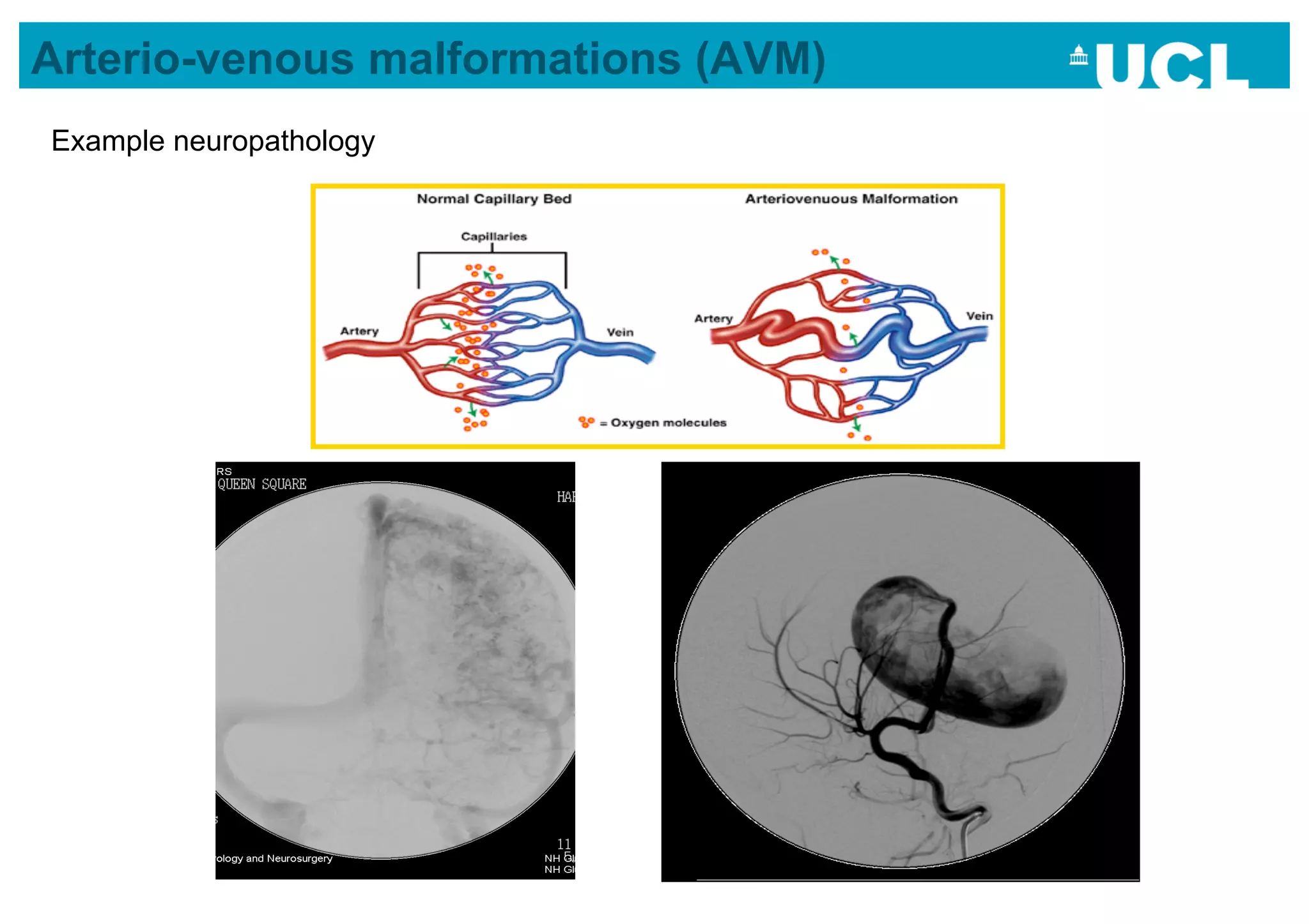 Arterio-venous malformations (AVM)
Example neuropathology
 