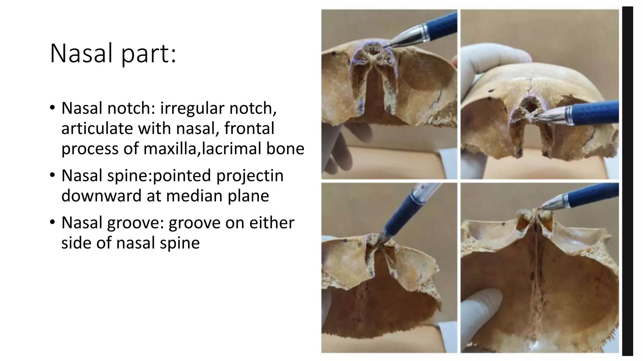 Nasal part:
• Nasal notch: irregular notch,
articulate with nasal, frontal
process of maxilla,lacrimal bone
• Nasal spine:pointed projectin
downward at median plane
• Nasal groove: groove on either
side of nasal spine
 
