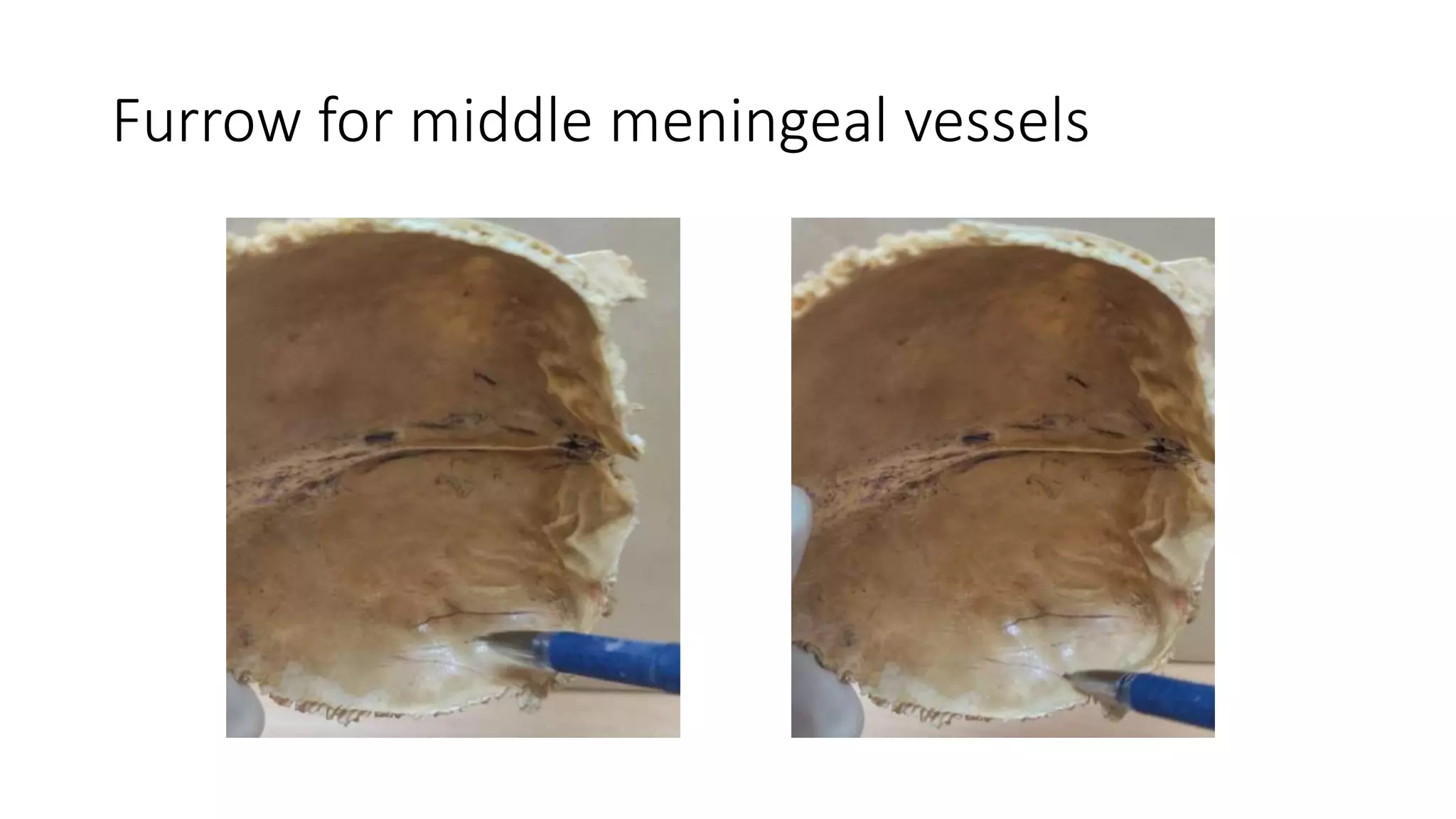 Furrow for middle meningeal vessels
 