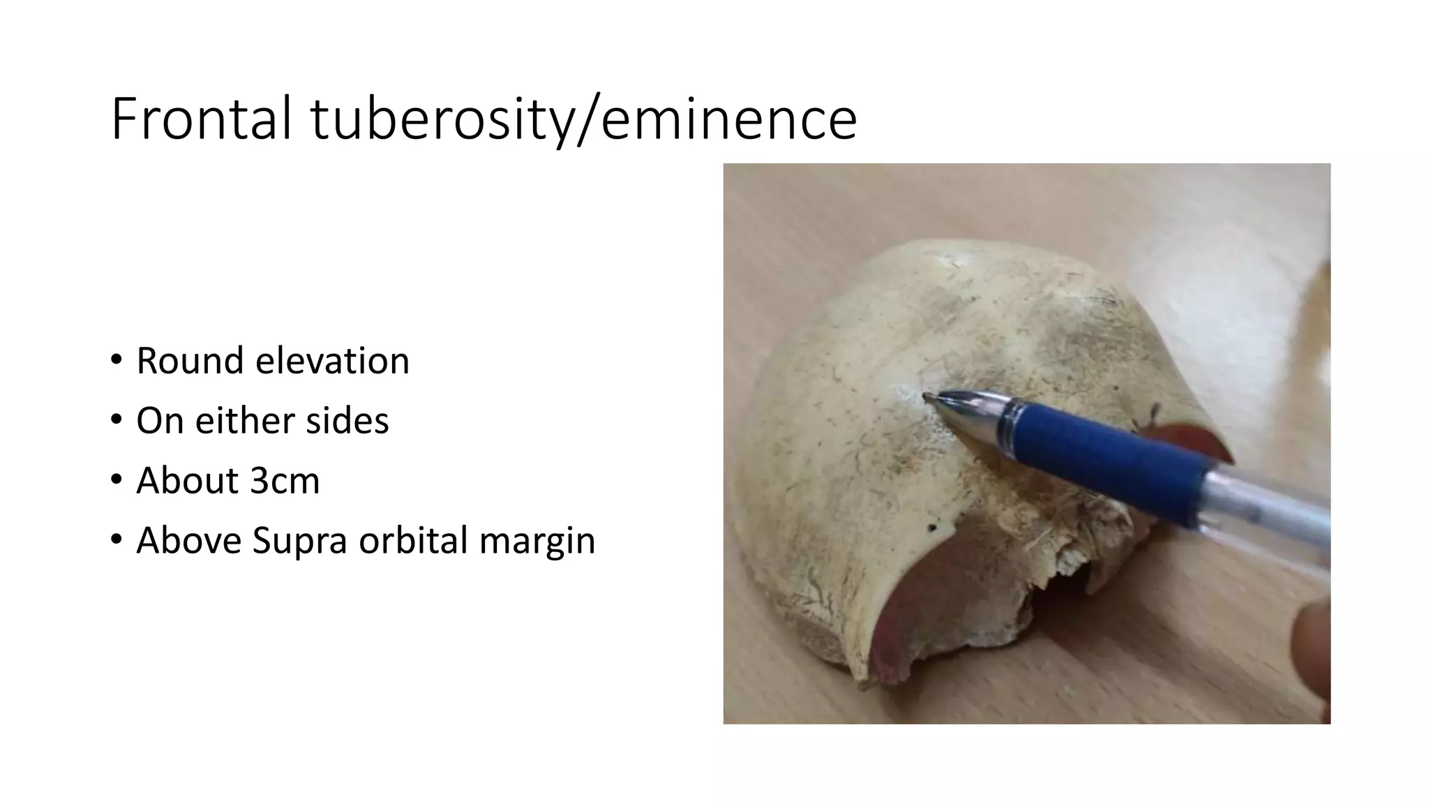 Frontal tuberosity/eminence
• Round elevation
• On either sides
• About 3cm
• Above Supra orbital margin
 