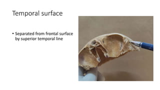 Temporal Ridge One Frontal bone ppt (1) | PPTX