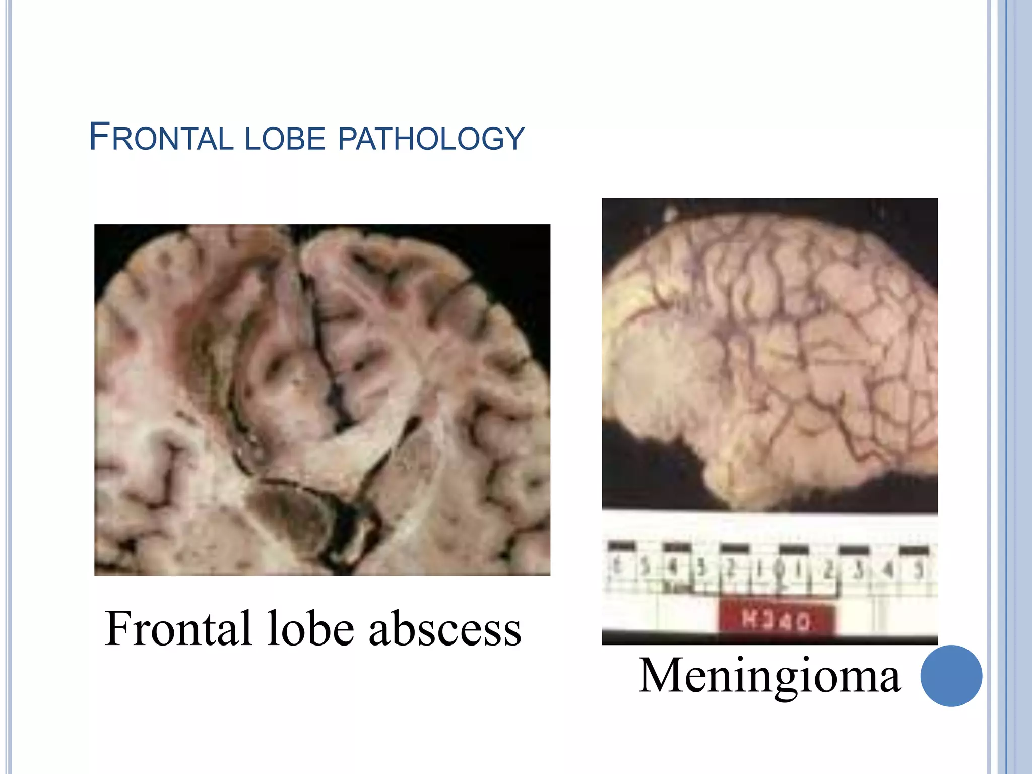 FRONTAL LOBE PATHOLOGY




Frontal lobe abscess
                         Meningioma
 