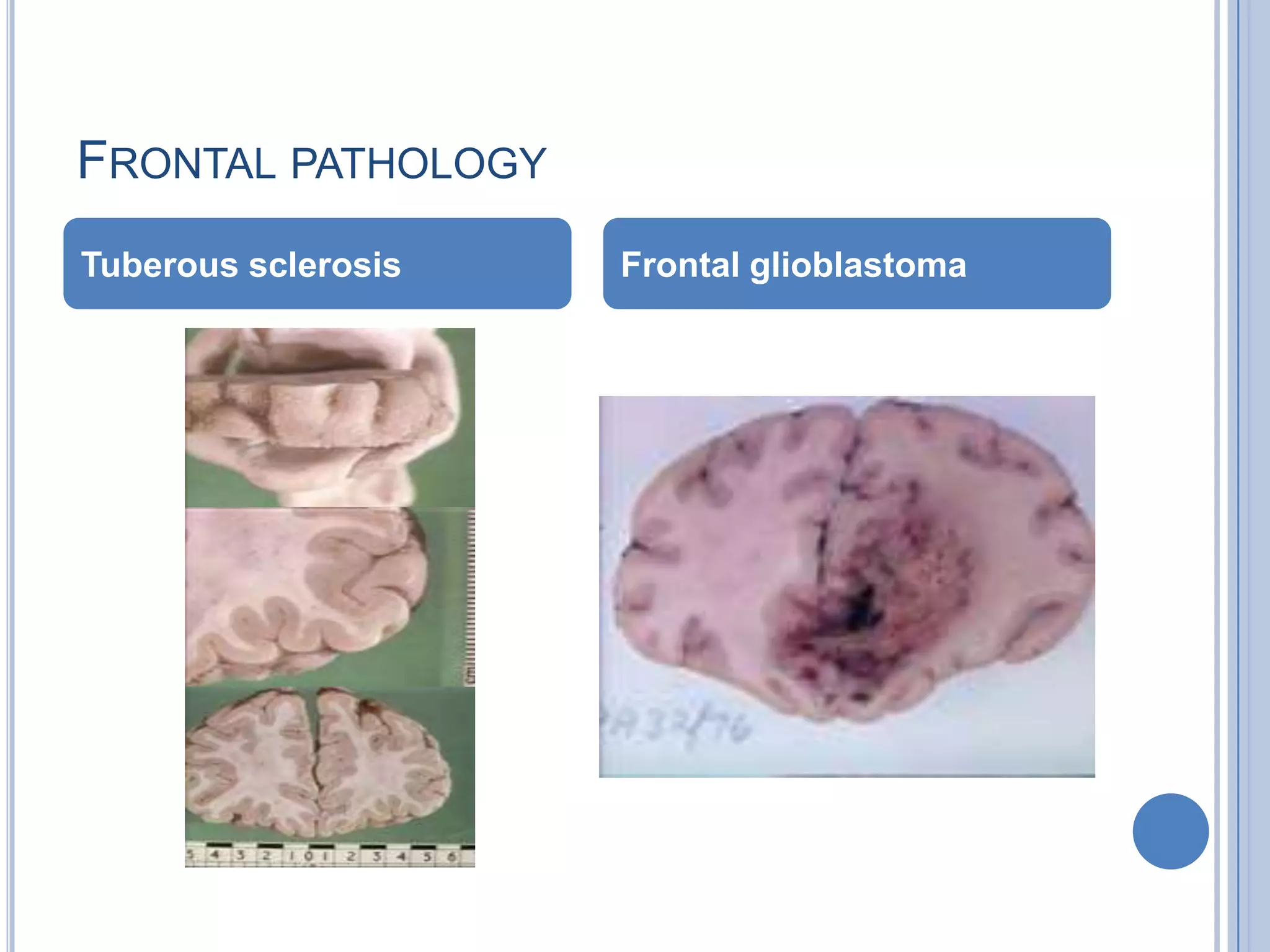 FRONTAL PATHOLOGY
Tuberous sclerosis   Frontal glioblastoma
 