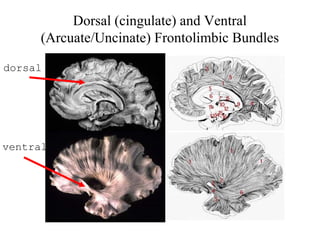 Dorsal (cingulate) and Ventral
(Arcuate/Uncinate) Frontolimbic Bundles
dorsal
ventral
 