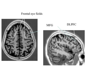 MFG
Frontal eye fields
DLPFC
 