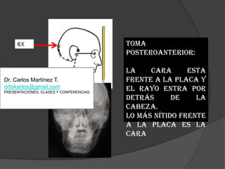 Toma PosteroAnterior:La cara esta frente a la placa y el rayo entra por detrás de la cabeza.Lo más nítido frente a la placa es la caraRxDr. Carlos Martínez T.ortokarlos@gmail.comPRESENTACIONES, CLASES Y CONFERENCIAS.