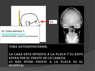 RxDr. Carlos Martínez T.ortokarlos@gmail.comPRESENTACIONES, CLASES Y CONFERENCIAS.Toma Anteroposterior:La cara esta opuesta a la placa y el rayo entra por el frente de la cabeza.Lo más nítido frente a la placa es el occipital