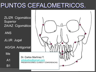 PUNTOS CEFALOMETRICOS.A1ZL/ZR  Cigomático         SuperiorZA/AZ  Cigomático ANSJL/JR  JugalAG/GA  AntigonialMeDr. Carlos Martínez T.ortokarlos@gmail.comPRESENTACIONES, CLASES Y CONFERENCIAS.B1
