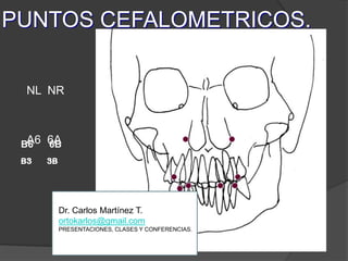 PUNTOS CEFALOMETRICOS.NL  NRA6  6AB6      6BB3       3BDr. Carlos Martínez T.ortokarlos@gmail.comPRESENTACIONES, CLASES Y CONFERENCIAS.