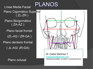 PLANOSLínea Media FacialPlano Cigomático Superior                  ( ZL-ZR )Plano Bicigomático      ( ZA-AZ )Plano facial frontal(ZL-AG / ZR-GA )Plano dentario frontal( JL-AG/ JR-GA)Plano oclusalDr. Carlos Martínez T.ortokarlos@gmail.comPRESENTACIONES, CLASES Y CONFERENCIAS.