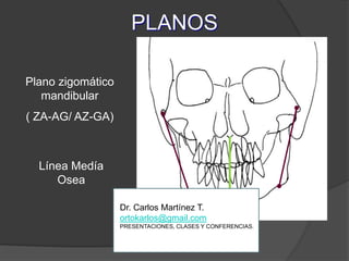 PLANOSPlano zigomático mandibular( ZA-AG/ AZ-GA)Línea Medía Osea Dr. Carlos Martínez T.ortokarlos@gmail.comPRESENTACIONES, CLASES Y CONFERENCIAS.