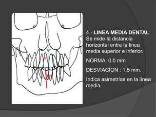 4.- LINEA MEDIA DENTAL:        Se mide la distancia horizontal entre la linea media superior e inferior.NORMA: 0.0 mmDESVIACION : 1.5 mm.Indica asimetrías en la línea mediaA1B1