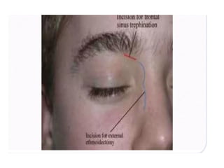 Approach to frontal sinus. Presentation. | PPTX