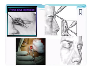 Approach to frontal sinus. Presentation. | PPTX