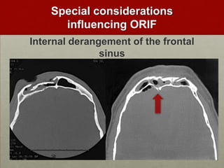 Special considerations
influencing ORIF
Internal derangement of the frontal
sinus

 