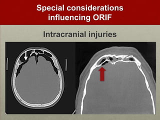 Special considerations
influencing ORIF
Intracranial injuries

 
