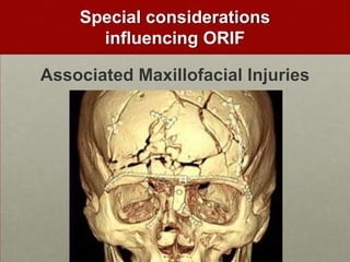 Special considerations
influencing ORIF
Associated Maxillofacial Injuries

 