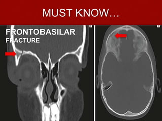MUST KNOW…
FRONTOBASILAR
FRACTURE

 