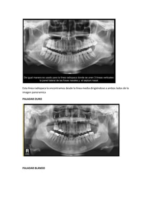 Esta línea radiopaca la encontramos desde la línea media dirigiéndose a ambos lados de la
imagen panoramica

PALADAR DURO




PALADAR BLANDO
 