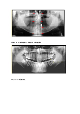 RAMA DE LA MANDIBULA (IMAGEN FANTASMA)




BLOQUE DE MORDIDA
 