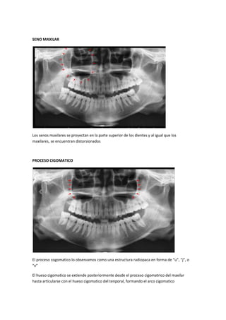 SENO MAXILAR




Los senos maxilares se proyectan en la parte superior de los dientes y al igual que los
maxilares, se encuentran distorsionados



PROCESO CIGOMATICO




El proceso cogomatico lo observamos como una estructura radiopaca en forma de “u”, “j”, o
“v”

El hueso cigomatico se extiende posteriormente desde el proceso cigomatrico del maxilar
hasta articularse con el hueso cigomatico del tenporal, formando el arco cigomatico
 