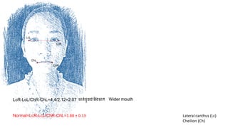 LcR-LcL/ChR-ChL=4.4/2.12=2.07
LcR
LcL
ChR
ChL
Lateral canthus (Lc)
Cheilion (Ch)
Normal=LcR-LcL/ChR-ChL=1.88 ± 0.13
Wider mouthមាត់ដូចជាវែងក្េក
 