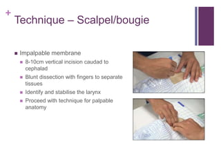 +
Technique – Scalpel/bougie
 Impalpable membrane
 8-10cm vertical incision caudad to
cephalad
 Blunt dissection with fingers to separate
tissues
 Identify and stabilise the larynx
 Proceed with technique for palpable
anatomy
 