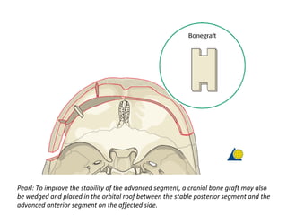 Pearl: To improve the stability of the advanced segment, a cranial bone graft may also
be wedged and placed in the orbital roof between the stable posterior segment and the
advanced anterior segment on the affected side.
 