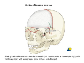 Grafting of temporal bone gap
Bone graft harvested from the frontal bone flap is then inserted in the temporal gap and
held in position with a resorbable plate (infants and children)
 