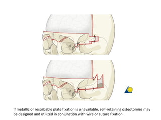 If metallic or resorbable plate fixation is unavailable, self-retaining osteotomies may
be designed and utilized in conjunction with wire or suture fixation.
 